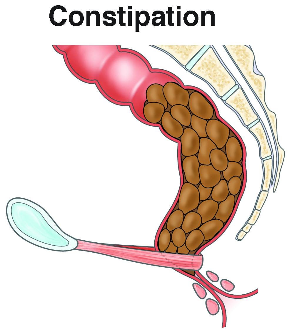 2018320191926-Constipation1