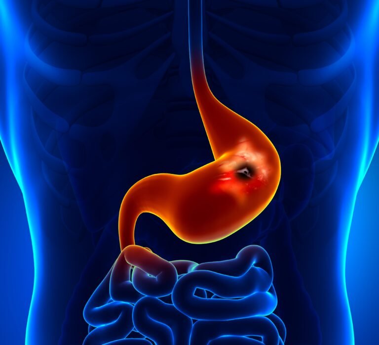 PepticUlcer_share
